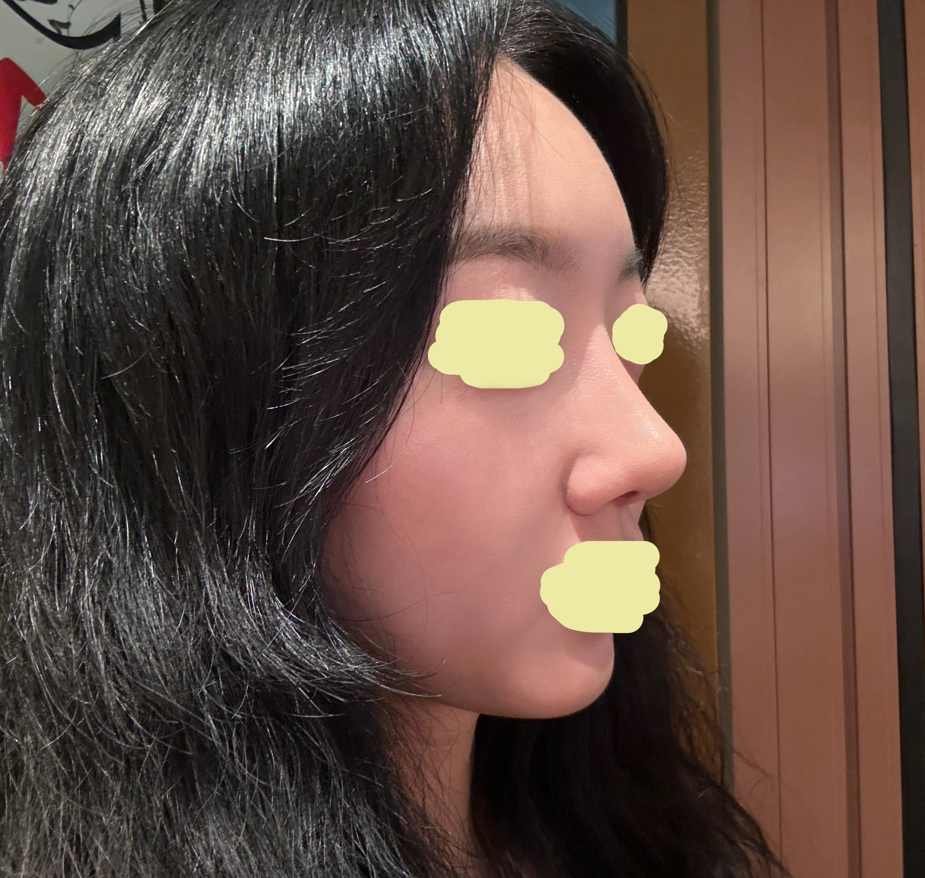 코랑 풀페이스지방이식 같이했어용