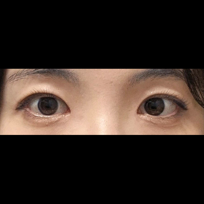 눈수술하고 예쁘다는 말 많이 들어요~