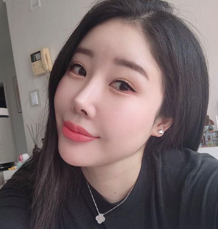 유영문원장님께 수술받은지 1년차!!