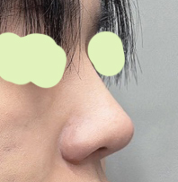 남자코성형찾으시는 분은 바이브로 가세요 ㅎㅎ만족