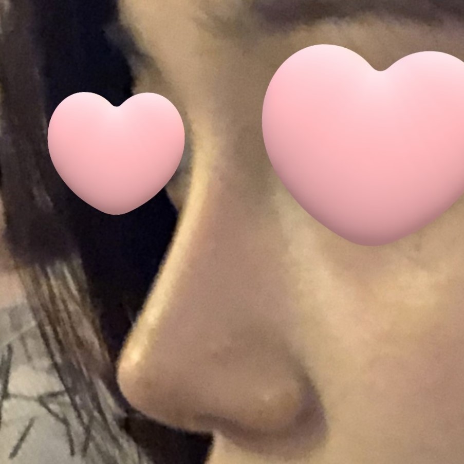 코수술 후 행복하게 살고있어용