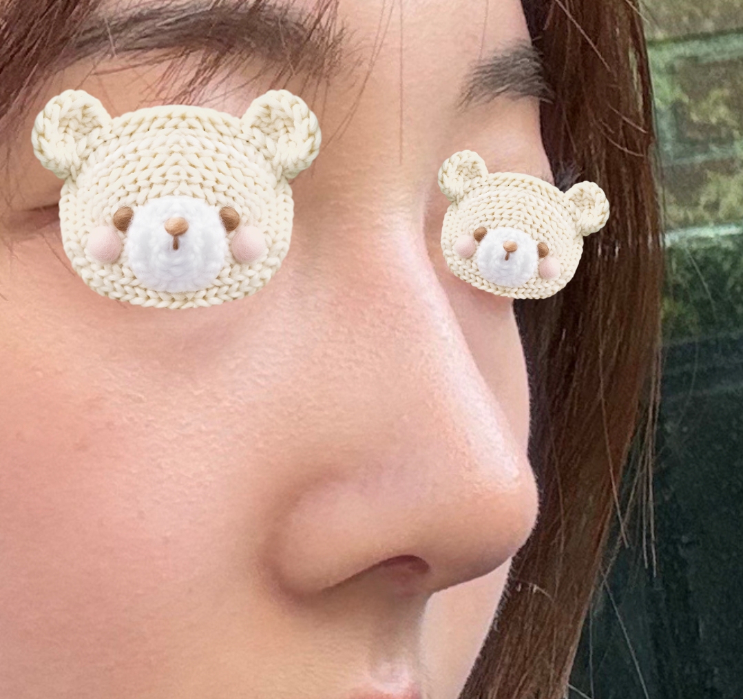 무보형물 코수술한지 반년지난 후기