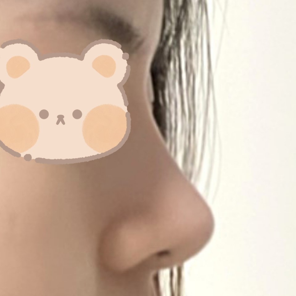 유원장님께 코수술 받은지 벌써 6개월이 지났습니다 ~!