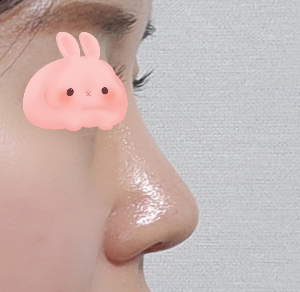 넘만족스런 코수술 후기 썼어요 ㅎㅎ