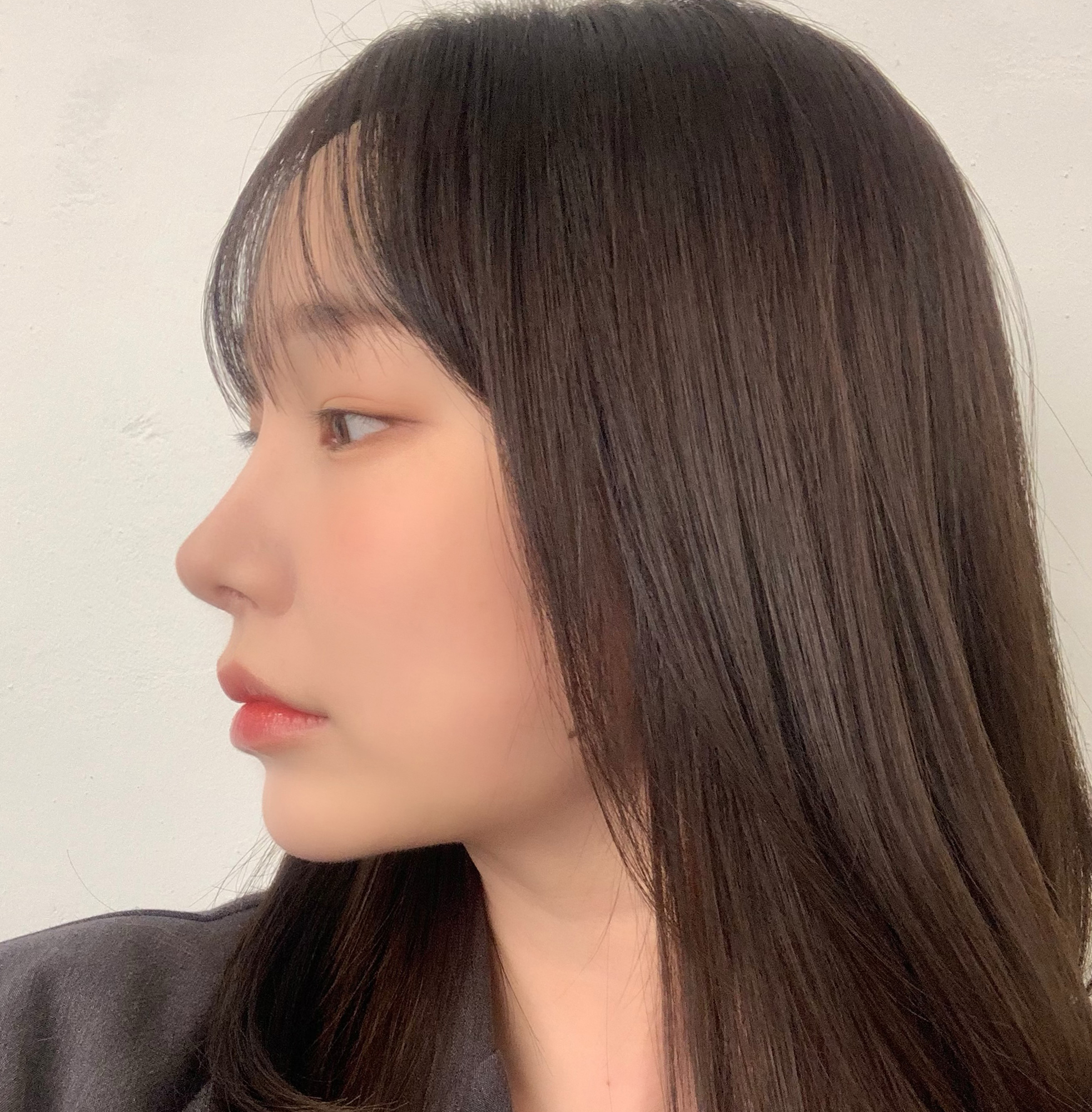 코재수술&내시경이마거상 찐찐후기