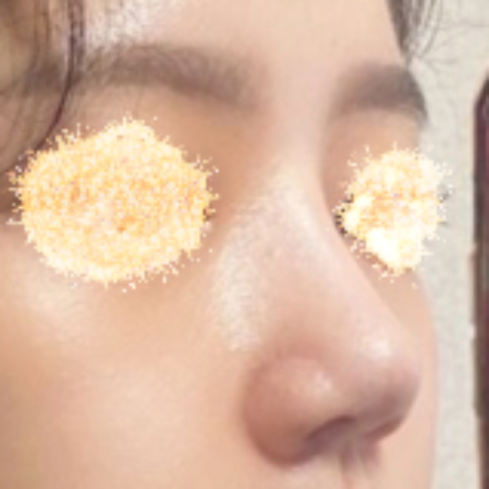 코수술 성공이에요! 감사합니다 원장님 ><