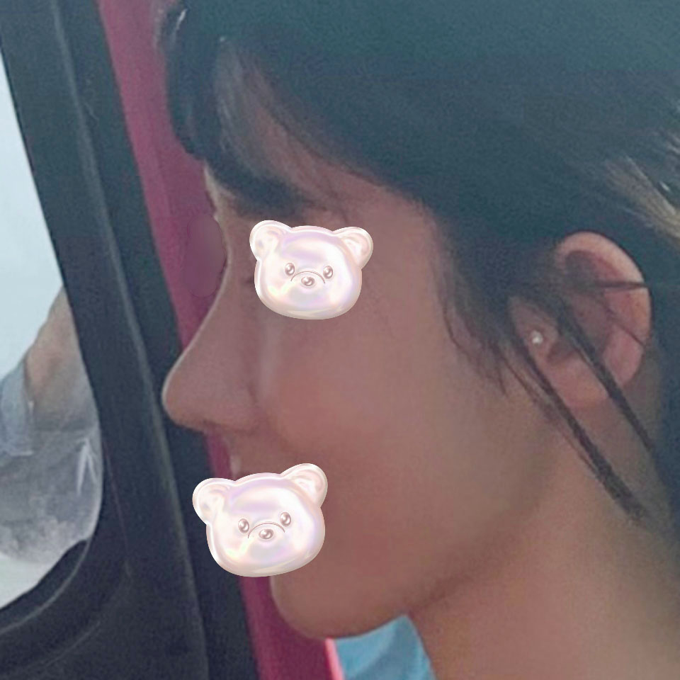 무보형물 코재수술 3주차