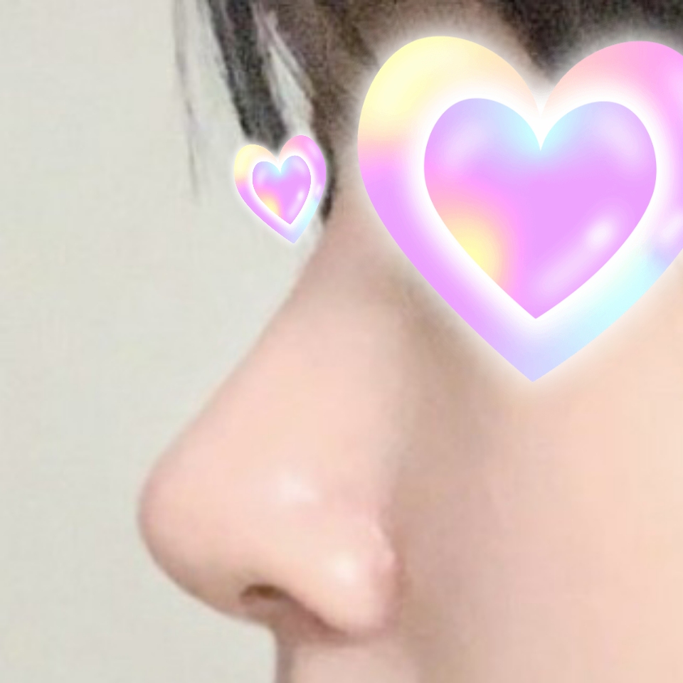 말 안하면 아무도 몰라용 제 코 같은 자연스러움 입니당 ㅎ.ㅎ