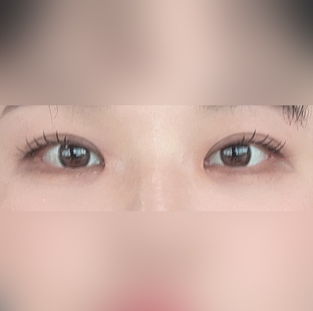 겹쌍꺼풀, 짝눈, 앞트임 고민 해결했어요!