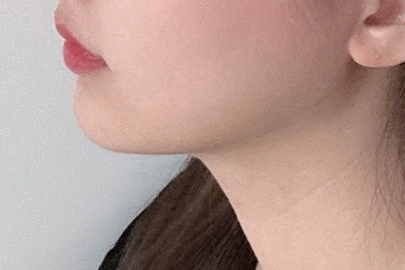 이젠 이중턱때문에 스트레스 안받아요 !