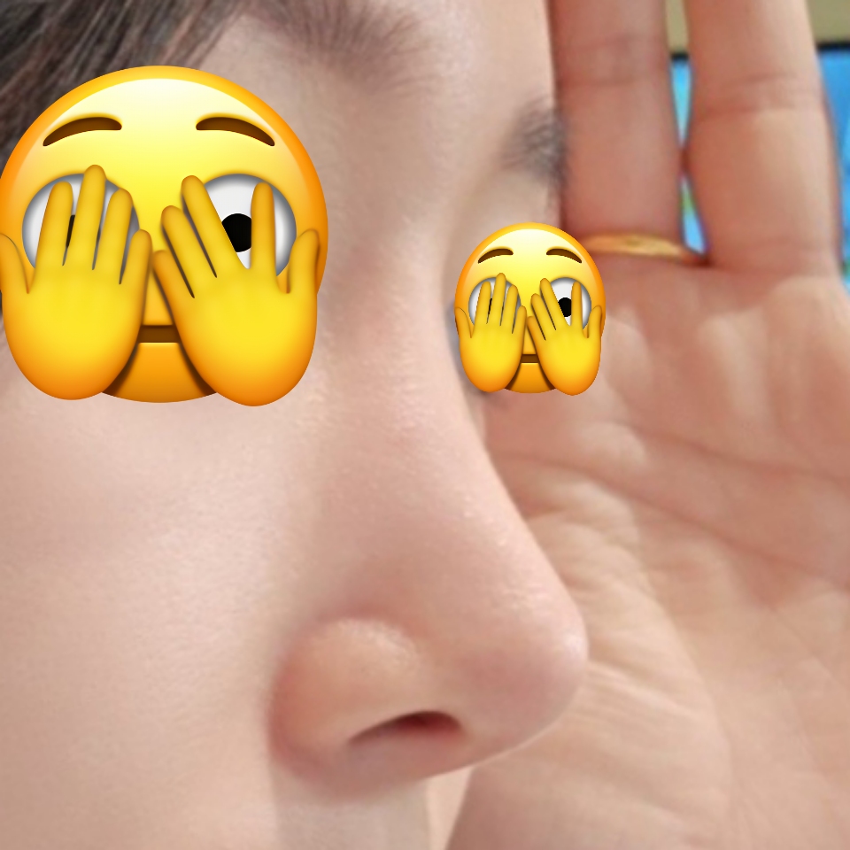 코수술 만족합니다 ~!