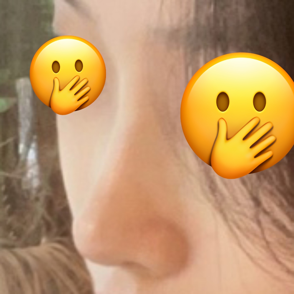 바이브에서 수술하길 잘한거같아요><