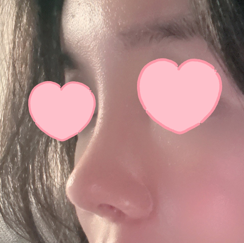 코재재수술,, 세번째 수술을 바이브에서 했어요.