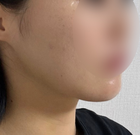 턱밑살이 있었는데?없어졌슴당