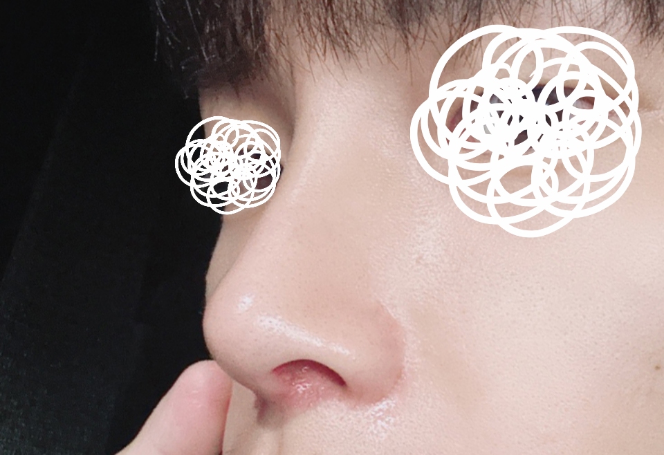 남자코성형 강력추천입니다