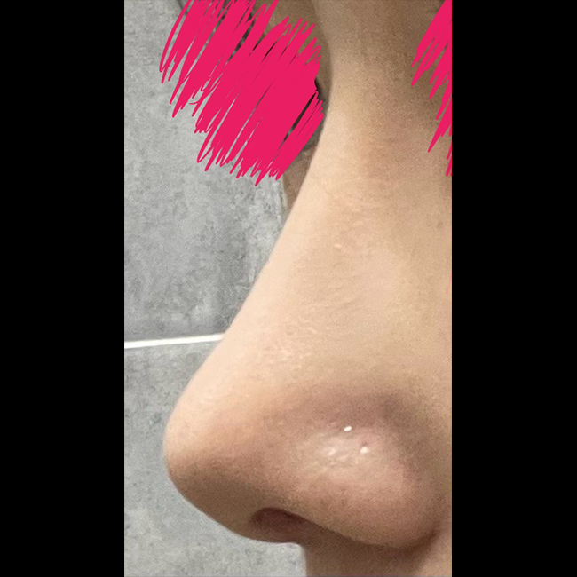 라인 굉장히 마음에 들어요! 코수술1갤차!!