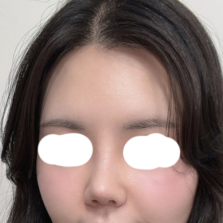 코수술,지방이식 2개월차 만족스러운 후기!