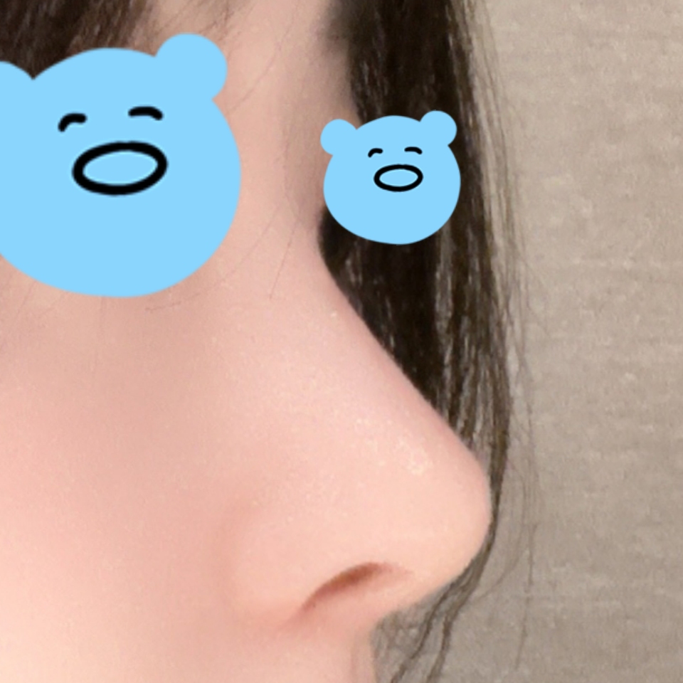 코성형 고민중이시면 바이브 추천하고 싶습니다!