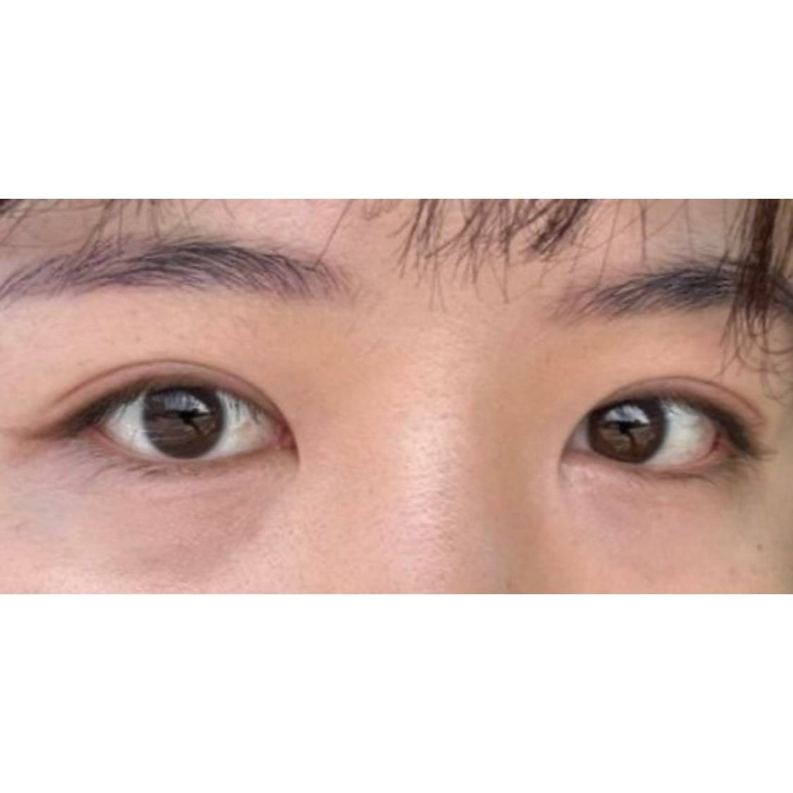 눈 수술 말 안하면 아무도 몰라용 ㅎㅎ