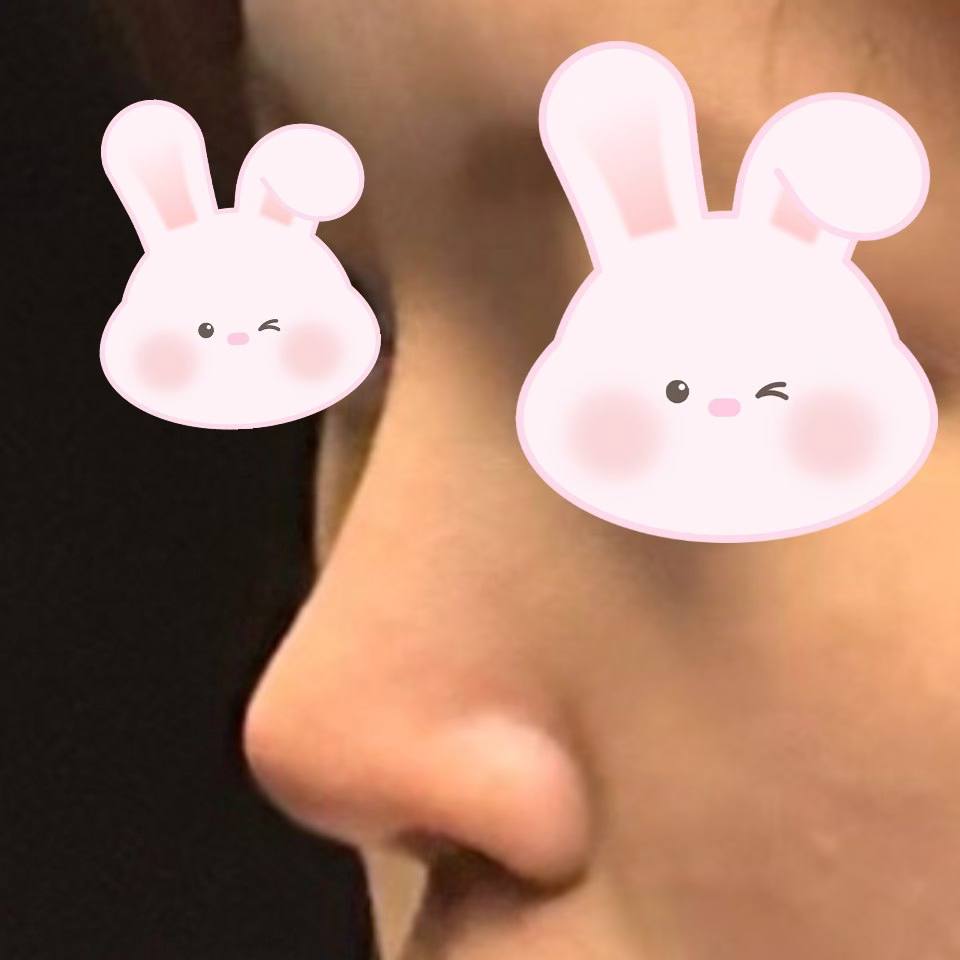 코수술 후 얼굴이 조화로워 졌어요 ㅎㅎ