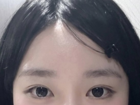 눈수술 후 예쁘다는 말을 자주 들어요 ㅎㅎ
