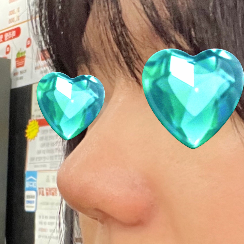 코성형한지 1개월차 됐습니다 ~