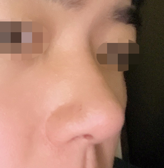 무보형물 코수술 만족도 높습니다