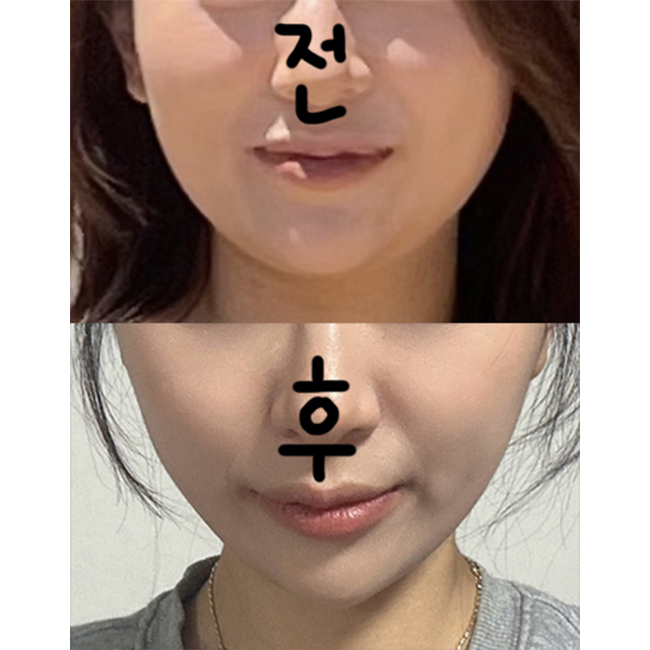 얼굴지방흡입하고 갸름갸름