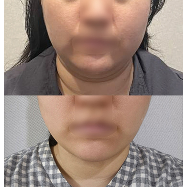 수술전후정면_1_.jpg