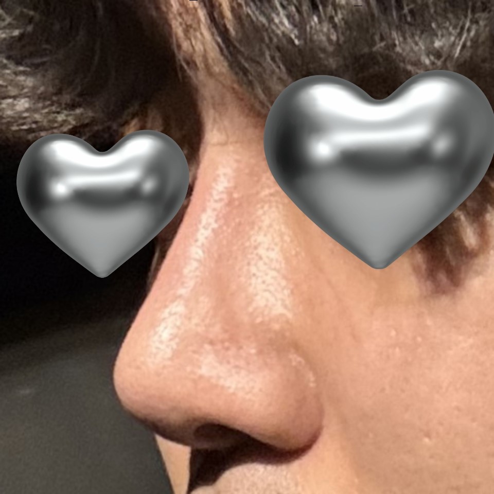 코성형 바이브 성형외과 추천 드립니다