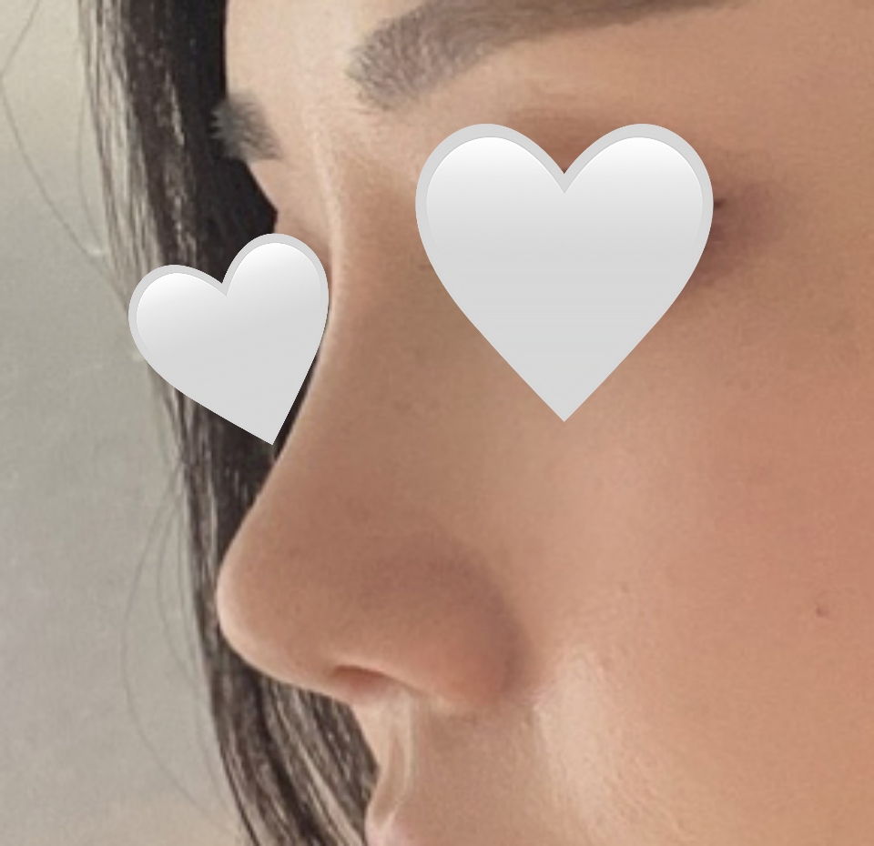 짧은코 재수술 2달 넘었습니다!