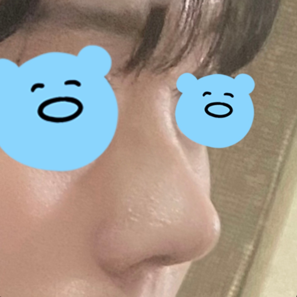 코수술 잘한 선택이에요 ㅎㅎ 만족합니당