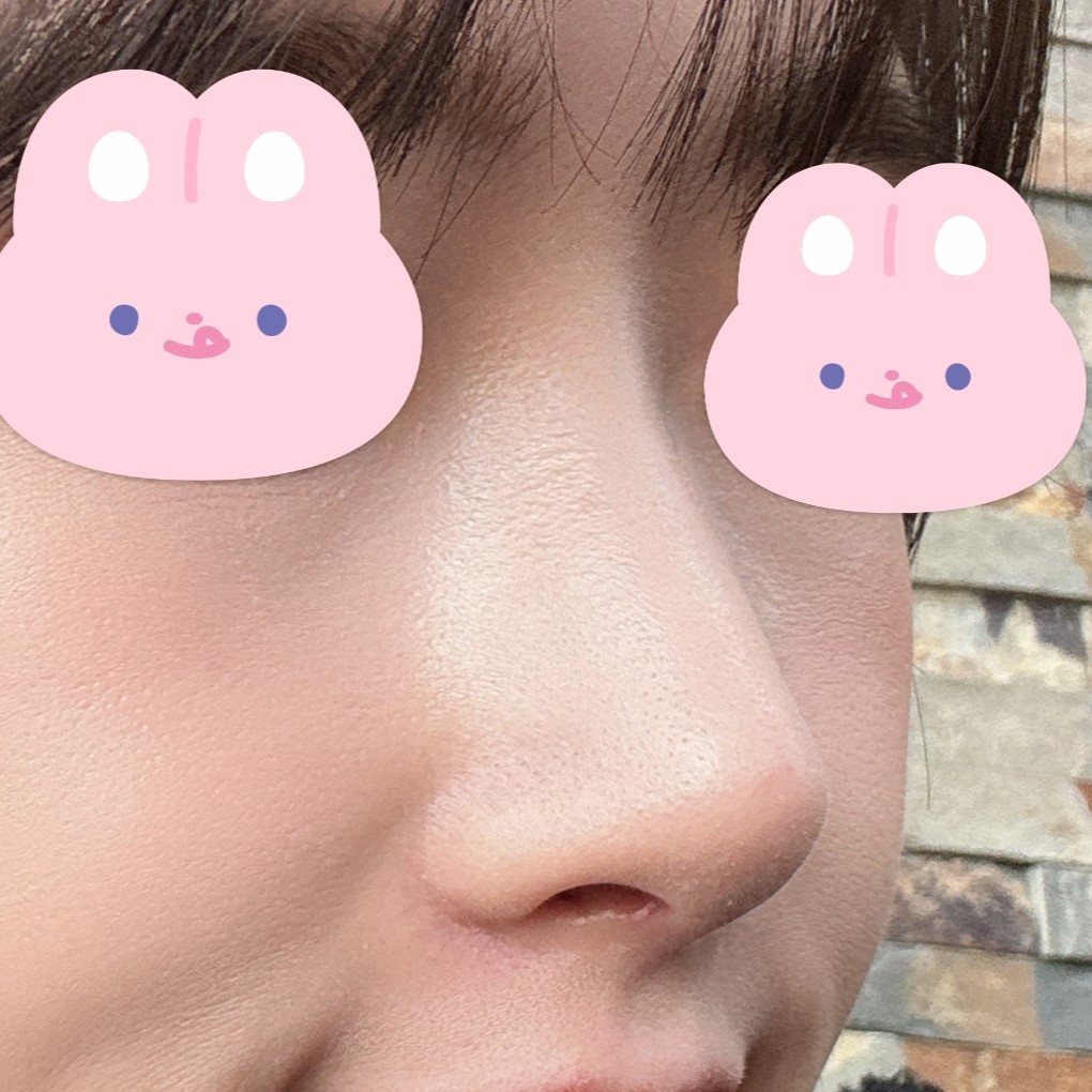 매부리 개선되고 여성스러워졌어요 ㅎㅎ