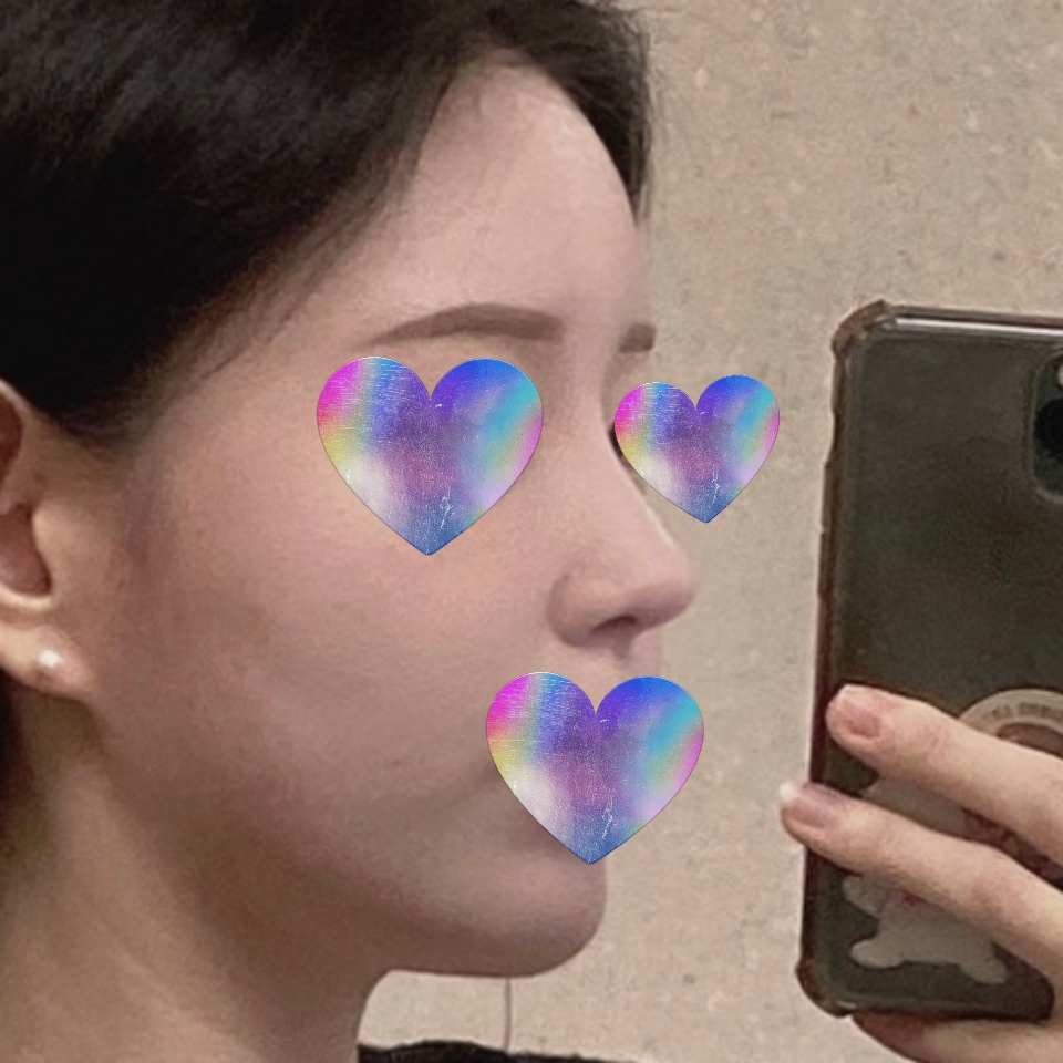 코성형 + 풀페이스 지방이식 이미지 변신 성공~