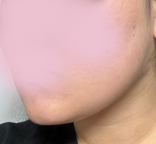 이중턱지흡하니 지방 쏙! 없어짐요