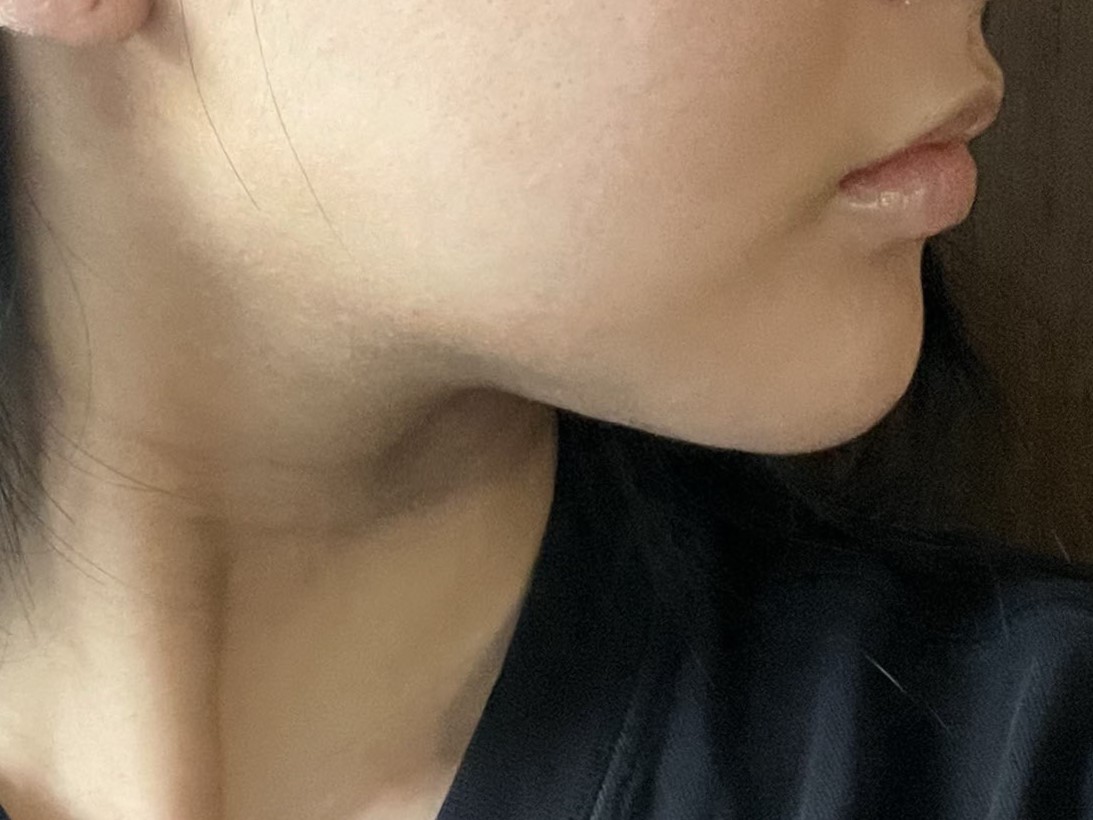 얼굴지방흡입 한지 1개월 지났어용