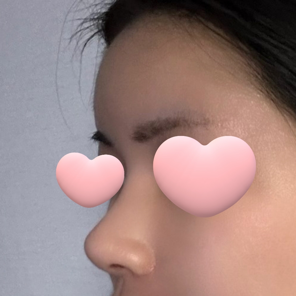 수술 고민하시는 분들 당장 바이브로 달려가세요 ~!