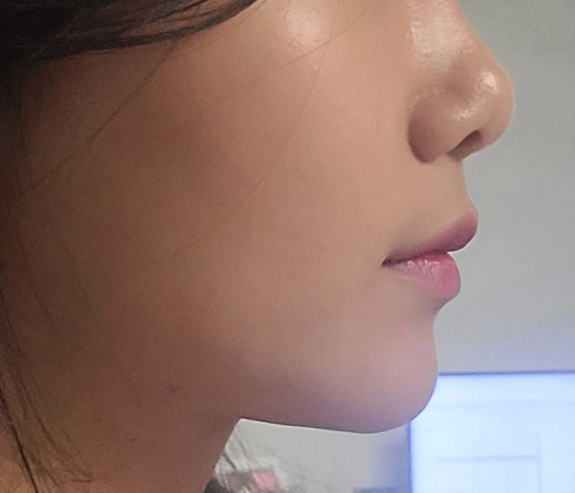 지방흡입2달차, 매우 만족중