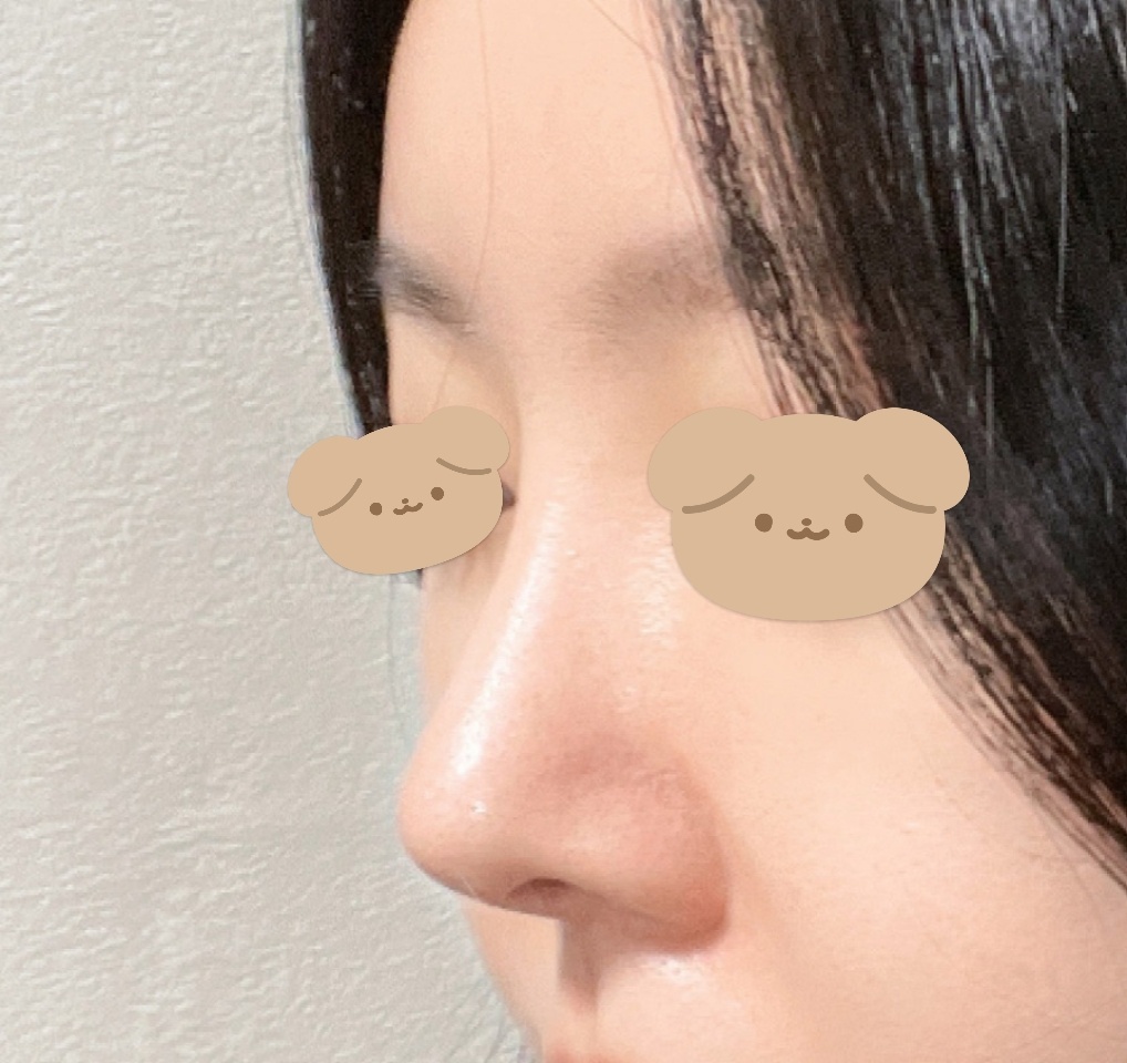 눈재수술이랑 코한지 벌써 6개월차됐어용