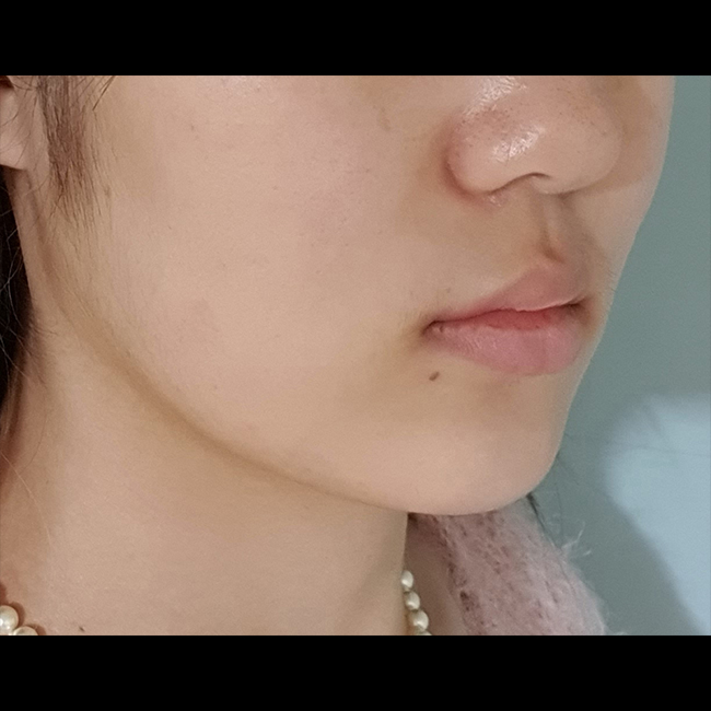 이중턱 전보다 줄어들어서 얼지흡 후회없어요!