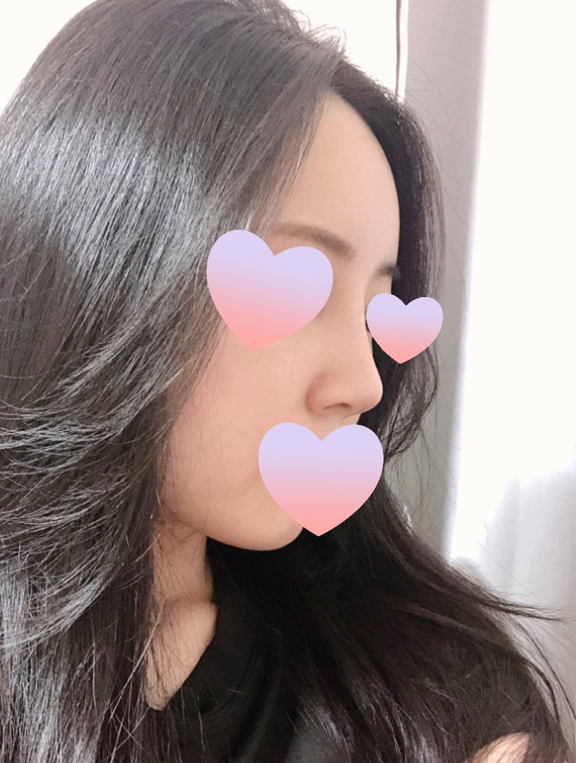 이마지방이식 + 코수술 후 3주차입니다!