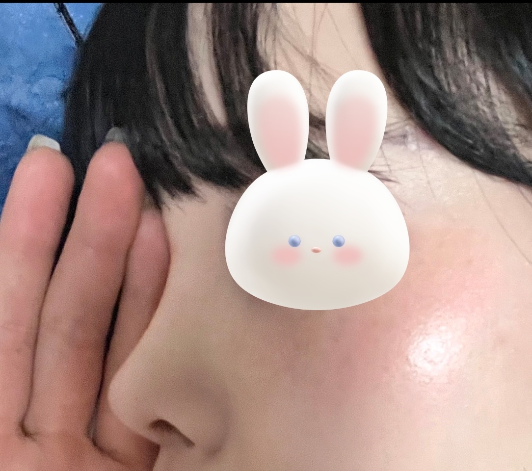 코성형 4개월차! 수술한지 까먹을정도ㅎㅎ자연스러워요