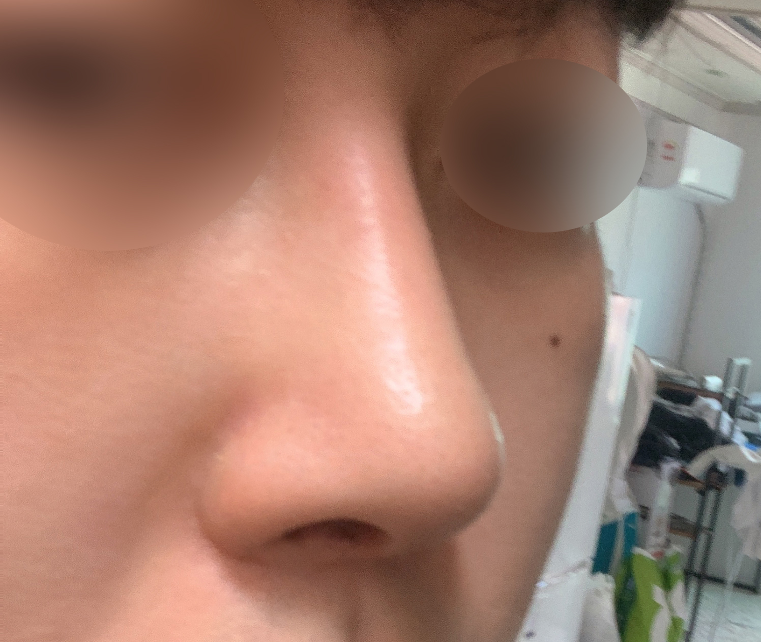 코수술 잘된것 같아 후기써요^^