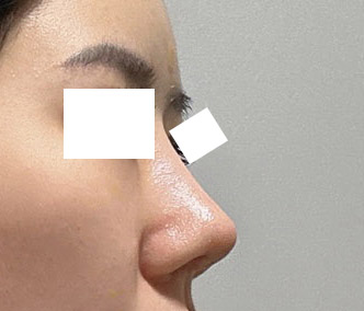 첫코수술 매우 만족중ㅎ