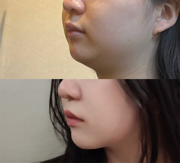 수술전후_측면_.jpg
