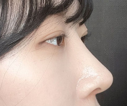 눈재수술 코수술 했어요:)