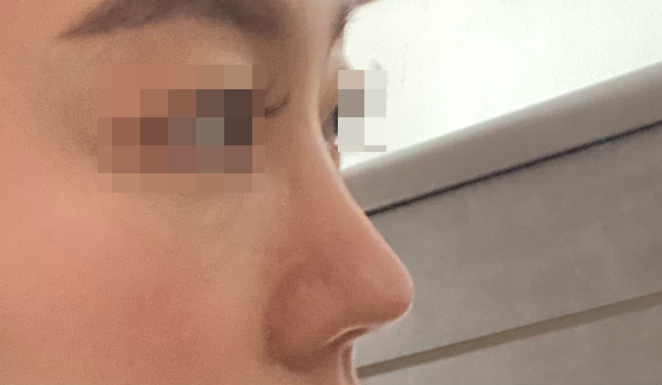 눈,코 했는데 주변에서 많이 물어봐요!