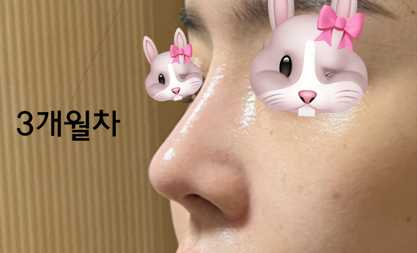 유원장님께 코재수술받았어요~ 후회없습니다ㅎㅎ