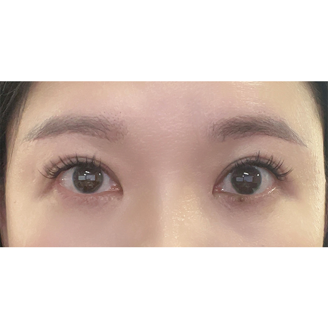 눈성형 5개월차후기요~~