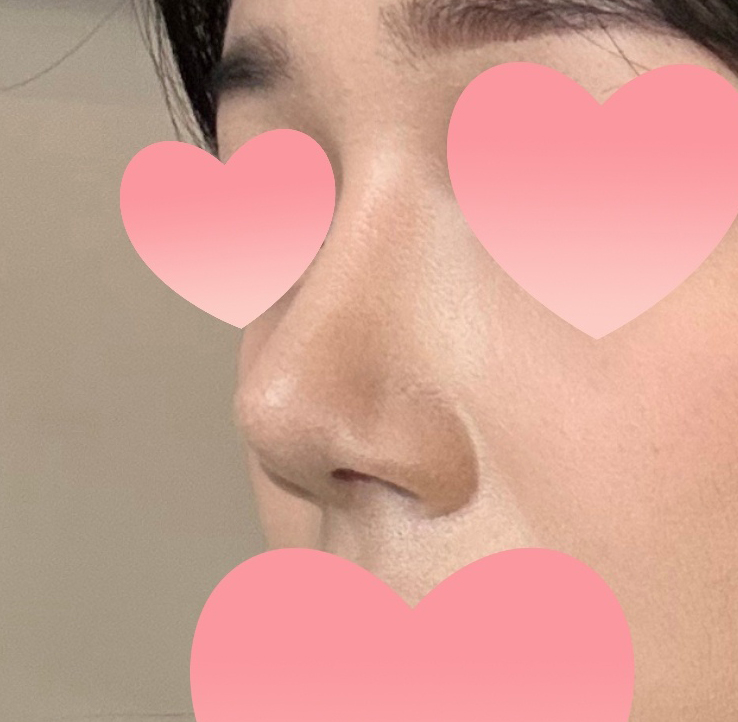 코수술한지 3달 넘고 쓰는 만족후기!!